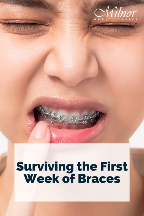 Surviving the First Week of Braces Braces Care Kit, Things To Eat After Getting Braces, Clear Bands On Braces, Braces What To Expect, Things To Eat When You Have Braces, Braces Kit Survival, Soft Food Braces Ideas, Metal Braces Aesthetic, Life With Braces