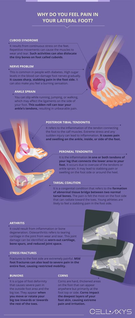 Why Do You Feel Pain in Your Lateral Foot Foot Pain Chart, Cuboid Syndrome, Ankle Pain Relief, Physical Therapy Exercises, Ankle Pain, Pain Relief Cream, Foot Pain Relief, Nerve Pain Relief, Sciatic Nerve Pain