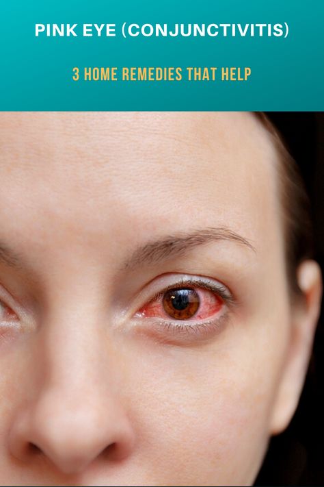 Pink Eye Relief, Pink Eye Remedy, Itching Remedies, Remedies For Dry Mouth, Pinkeye Remedies, Cold Sore Relief, Hygiene Activities, Home Remedies For Allergies, Home Remedies For Warts