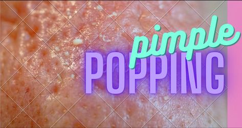 Satisfying Pimple Popping Deep Pimples Under Skin, Huge Pimple Poppìng, Satisfying Pimple Videos, Ear Pimple Poppìng Videos, Huge Pimple Pop Video, Satisfying Pimple Videos Popping, Big Pimple Poppìng Videos, Pimple Poppìng Videos New, Cystic Pimple Pop