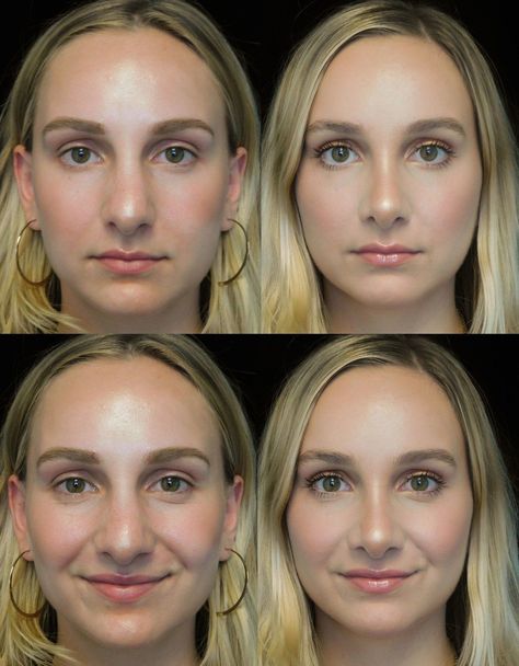 Your Guide to Rhinoplasty, From Cost to Recovery Time | Life in Plastic Nose Job Inspiration, Jaw Reduction Surgery, Nose Plastic Surgery, Nose Surgery Rhinoplasty, Nose Job Inspo, Bulbous Nose, Plastic Surgery Fail, Rhinoplasty Nose Jobs, Rhinoplasty Before And After