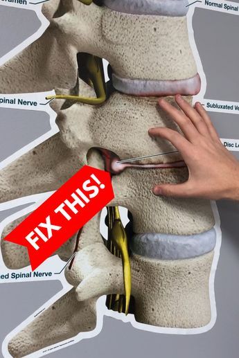 Bulging Disc Exercises, Dr Rowe, K Tape, Stomach Exercises, Back Health, Bulging Disc, Back Relief, Sciatica Exercises, Sciatica Pain Relief