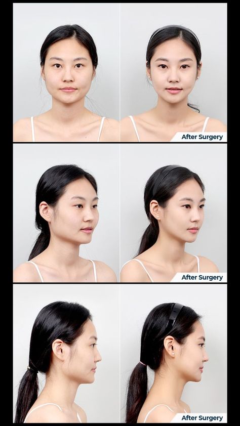 Before and After Cheekbone Reduction, Jaw Reduction and Genioplasty Zygoma Reduction, Face Plastic Surgery Before After, Face Contouring Surgery, Browbone Reduction, Cheekbone Reduction, Brow Bone Reduction, Cheek Reduction Surgery, Square Jaw Reduction, Plastic Surgery Before And After