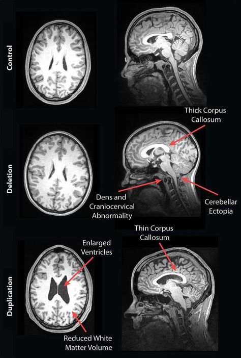 Mri Brain, Radiology Student, Corpus Callosum, Radiology Imaging, Brain Surgeon, Brain Images, Medical Wallpaper, White Matter, Brain Anatomy