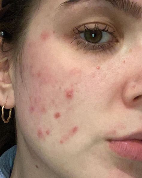 Diana’s Instagram profile post: “Anyone else having even more breakouts due to face masks? Need to try and find better materials😭 #acne #maskcne #maskne #spots #breakout…” Acne Insecurities, Breakouts On Face, Handsome Black Boy, Black Boy Fashion, Growing Confidence, Acne Positivity, Skin Positivity, Regular Skin Care Routine, Acne Beauty