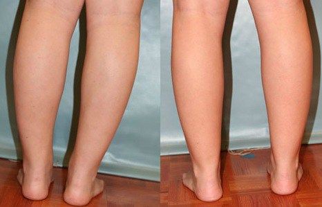 Large Calves and Ankles Ugly Legs, Fat Calves, Slim Calves, Thick Calves, Pretty Socks, Calf Leg, Heavy Legs, Big Calves, Free Powerpoint Templates