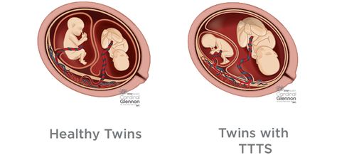 TTTS, twin to twin transfusion syndrome Nicu Nurse Education, Twins In The Womb, Holistic Birth, Types Of Twins, Pathophysiology Nursing, Obstetrics Nursing, Obstetric Ultrasound, Pregnancy Eating, Sonography Student