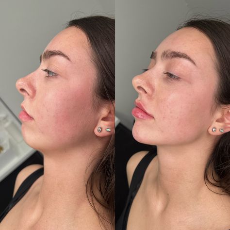 Chin, Lip & Jawline Filler. ✨💉 Jaw Surgery Aesthetic, Botox Cheeks Before After, Chin Jaw Filler, Before And After Jaw Filler, Cheek And Chin Fillers Before After, Profile Balancing Fillers, Chin And Lip Filler, Jaw Contouring Filler, Pixie Tip Lift Nose Filler