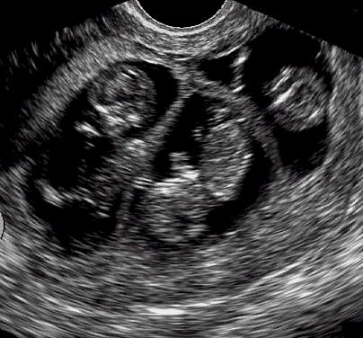 Ultrasound image of triplets at approximately 11 weeks of gestation. Twins Ultrasound Aesthetic, Triplets Ultrasound, Triplet Aesthetic, Sonographer Aesthetic, Ultrasound Aesthetic, Triplets Aesthetic, Triplets Pregnancy, Baby Ultrasound, Triplet Babies