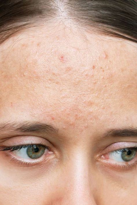 Types Of Acne On Face, Calcium Deposits On Face, Acne Is Beautiful, Closed Comedones, Comedonal Acne, Body Soul Mind, Healing Together, My Insecurities, Forehead Acne