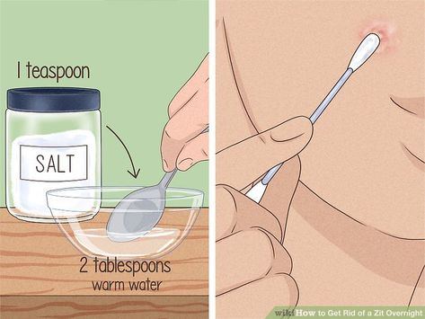 How to Get Rid of a Zit Overnight (with Pictures) - wikiHow Clear Pimples, Clear Skin Overnight, How To Clear Pimples, Clear Skin Fast, Get Rid Of Pimples, Rid Of Pimples, Pimples Remedies, Pimples Overnight, How To Get Rid Of Pimples