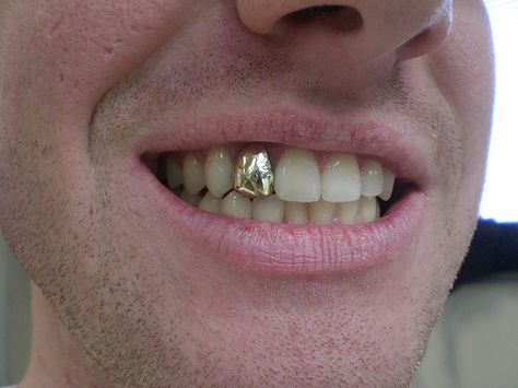 Gold Teeth Men, Canine Grillz, Permanent Gold Teeth, Gold Tooth Cap, Grill Teeth, Golden Tooth, Gold Grills, Tooth Cap, Lake Worth Florida