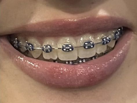 Straight Teeth Braces, Gray Braces Teeth, Braces Vision Board, Straight Teeth With Braces, Braces Astethic, Black Braces Aesthetic, Braces On Crooked Teeth, Black Braces Teeth, Perfect Teeth Aesthetic