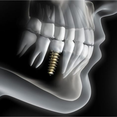 Dental Implants Staring at $249/mo. | Tooth Replacement | Dentures Ocala | Dental Implants Near Me Dental Advertising, Dental Implant Procedure, Denture Implants, Dental Posters, Best Dental Implants, Dentist Clinic, Dental Videos, Dental Implants Cost, Dental Fun