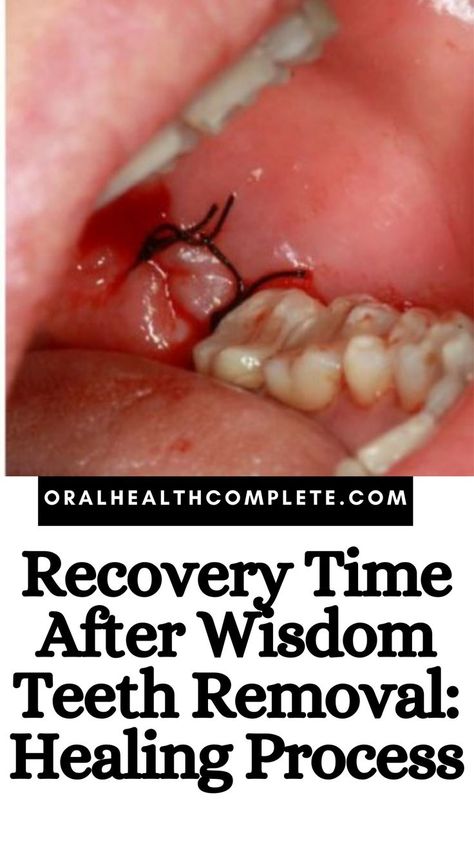 Recovery Time After Wisdom Teeth Removal What To Eat When Wisdom Teeth Removed, Foods For After Wisdom Teeth Removal, Recipes For After Wisdom Teeth Removal, After Wisdom Teeth Removal Food, Foods For Wisdom Teeth Removal, Soft Foods After Wisdom Teeth Removal, Wisdom Tooth Removal Food, Face Swelling Remedies, What To Eat After Wisdom Teeth Removal