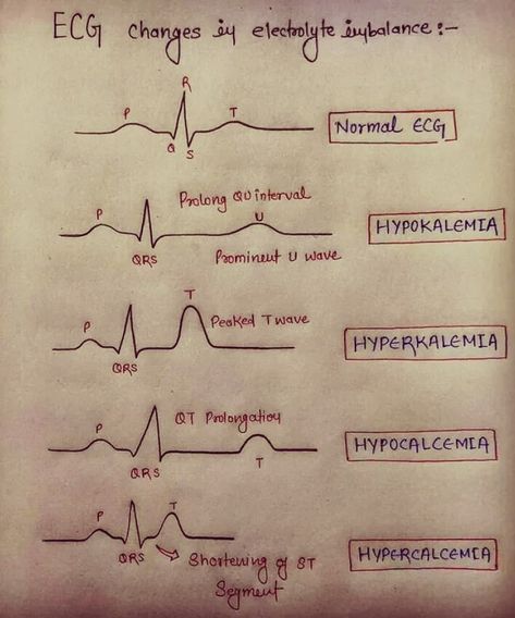 Medical Doctors Worldwide on Instagram: “ECG changes due to electrolyte imbalance #medical #cardiology #clinical #ecg #doctor” Cardiology Study, Medical Terminology Study, Medical Assistant Student, Medical School Life, Nursing School Essential, Nursing Mnemonics, Medical Student Study, Nurse Study Notes, Nursing Student Tips