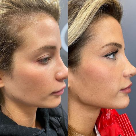 Jaw And Cheek Filler, Chin And Cheek Fillers, Naomi Southern Charm Hair, Naomi Olindo Style, Chin Enhancement Before After, Naomie Olindo Hair, Chin Implants Before And After, Jaw And Chin Filler Before And After, Cheek And Chin Fillers Before After