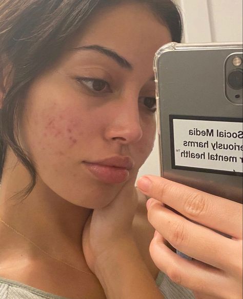 Girl With Acne Aesthetic, Pretty Insecurities, Celebrities With Acne, Girl With Acne, Acne Positivity, Celebrity Acne, Real Skin, Bare Beauty, Cindy Kimberly