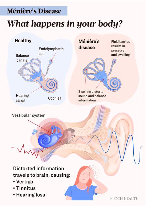 Ménière’s Disease: Symptoms, Causes, Treatments, and Natural Approaches | The Epoch Times Ménière’s Disease, Fluid In Ears, Ear Pressure, Vestibular System, Nursing Student Tips, Student Tips, Disease Symptoms, Patient Experience, Hearing Loss