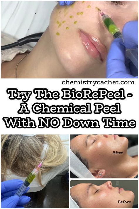 Head to Fringe Salon in Stephenville, TX for this fantastic chemical peel called BioRePeel. It's a chemical peel with no down time. It tightens pores, smooths and firms skins, treats acne and texture, and so much more. Learn how it works in our post! Biorepeel Before And After, At Home Chemical Peel Diy, Cosmelan Peel Before And After, Chemical Peel Results, Chemical Peeling, Face Peel Chemical, Chemical Peel Aftercare, Chemical Face Peel, Smaller Pores