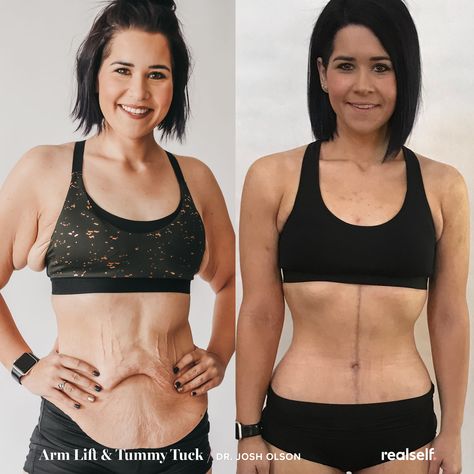 12 Things I Wish I Knew Before Tummy Tuck Surgery Loose Skin Surgery, Arm Lift Surgery, Body Lift Surgery, Tummy Tucks Recovery, Skin Removal Surgery, Mommy Makeover Surgery, Skin Tightening Stomach, Loose Belly, Tighten Loose Skin