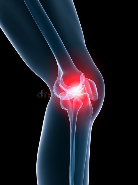 Painful knee. 3d rendered anatomy illustration of a human skeletal knee with pai , #spon, #rendered, #anatomy, #Painful, #knee, #skeletal #ad Knee Anatomy, Chi Nei Tsang, Knee Pain Exercises, Heart Healthy Diet, Shin Splints, Knee Pain Relief, Knee Replacement, Integrative Medicine, Healing Food