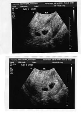 3 Weeks Pregnant Ultrasound Twins, Twin Ultrasound 6 Weeks, 3 Weeks Pregnant Ultrasound, 5 Week Ultrasound Pictures, 4 Weeks Pregnant Ultrasound, 5 Weeks Pregnant Ultrasound, Fake Ultrasound, Twins Ultrasound, Ivf Twins