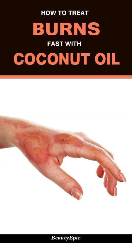 Coconut Oil For Burns, Burned Face, Burn Remedies, Burn Ointment, 2nd Degree Burns, Burn Remedy, Burn Relief, How To Heal Burns, Burn Care