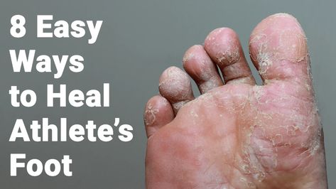 8 Easy Ways to Heal Athlete’s Foot Foot Fungus Remedies, Nail Remedies, Natural Antifungal, Nail Fungus Remedy, Nail Infection, Ways To Heal, Fungal Nail, Athletes Foot, Foot Soak