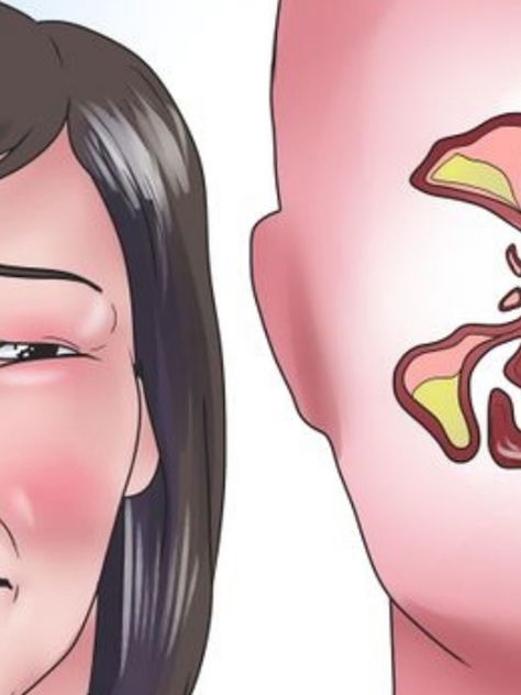 Stop Nose Bleeds, Clear Sinuses, Parts Of The Nose, How To Clear Sinuses, Clear Nose, Coconut Health, Nose Picking, Natural Remedies For Migraines, Reflux Diet