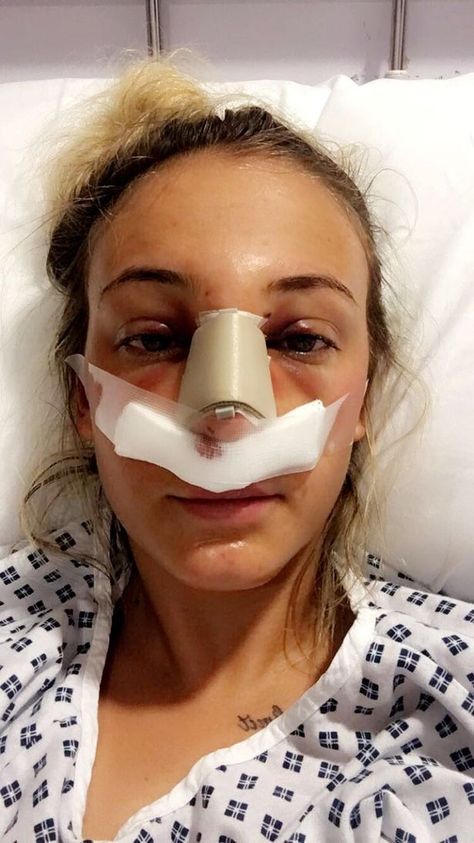 Student's new £5,000 nose broken in vicious high-heel attack while sat on nightclub toilet 'by old school friend' - Mirror Online Broken Nose Surgery, Nose Plastic Surgery, Holly Pictures, Broken Nose, Nose Surgery, Overcoming Adversity, Nose Job, Makeup Stuff, Getting Things Done