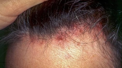 Scalp Folliculitis is a typical skin condition in which hair follicles become excited. It’s typically brought about by bacterial or fungal contamination. From the start, it might look like little red knocks or white-headed pimples around hair follicles Infected Hair Follicle, Sores On Scalp, Dark Patches On Skin, Blind Pimple, Pimples Under The Skin, Hair Detox, Scalp Problems, Shaving Your Head, Pimple Patches