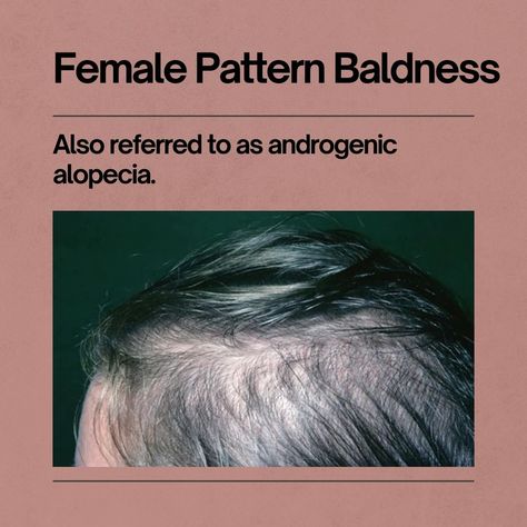 Female pattern baldness (androgenic alopecia) is a type of hair loss that causes baldness in women. Scroll through to learn more about its causes and symptoms.
.
Save this pin and share with a friend.
.
.
#femalepatternbaldness #androgenicalopecia #haircare #naturalhairtips #tipsforhair Androgenic Alopecia In Women, Micro Pigmentation, Androgenic Alopecia, Female Pattern Baldness, Game Storage, Pattern Baldness, Sleep Remedies, Bald Women, Skin Clinic