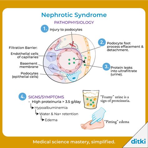 How do we diagnose Nephrotic Syndrome?  Learn more: https://ditki.com/course/pathology/glossary/term/nephrotic-syndrome-key-pathologies  #ditki #usmle #meded #medschool #medstudent #highered #mededonline #usmletutorials #pathology #nephroticsyndrome #renalpath #kidneypath #nursing #pance #physicianassistant #osteopath #allopath #medicine #science #healthscience #nurse #premed #mcat #mbbs Nephritic Syndrome, Focal Segmental Glomerulosclerosis, Glomerular Filtration, Pitting Edema, Clinical Pathology, Study Things, Basement Membrane, Nephrotic Syndrome, Viral Infection