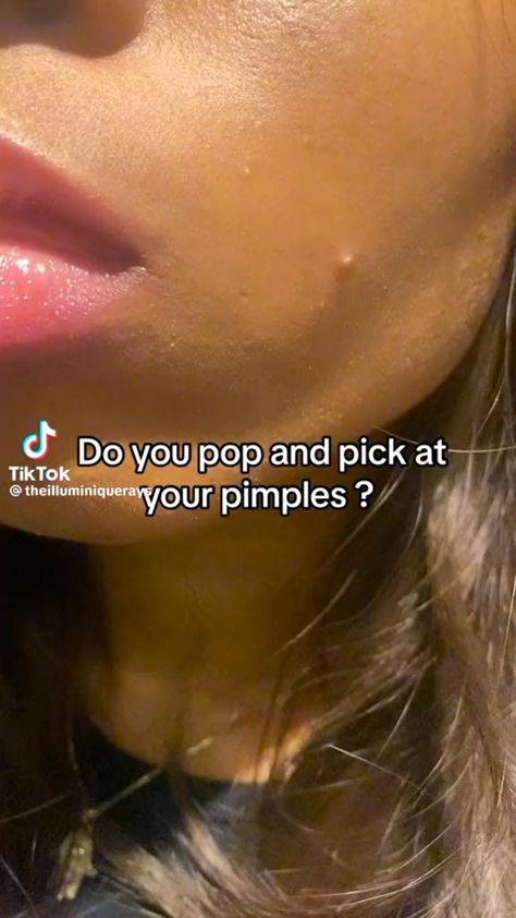 Get rid of pimples Pimple Hacks, Pimple Scar Removal, Getting Rid Of Scars, Regular Skin Care Routine, Get Rid Of Pimples, Rid Of Pimples, Forehead Acne, Pimple Scars, How To Get Rid Of Pimples