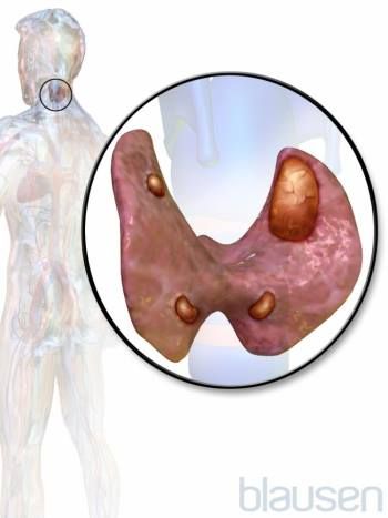 Hypercalcemia (High Level of Calcium in the Blood) - Hormonal and Metabolic Disorders - Merck Manuals Consumer Version Parathyroid Disease, Multiple Endocrine Neoplasia, High Calcium, Metabolic Disorders, Thyroid Health, Medical Knowledge, Hormone Health, Hormone Imbalance, Blood Test