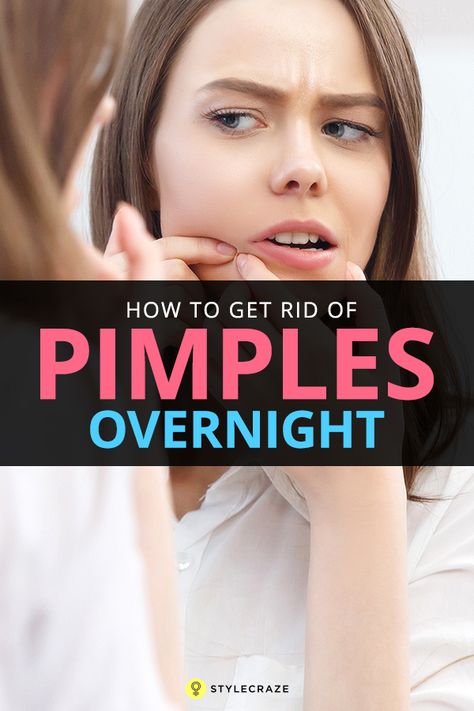 Get Rid Of Pimples Overnight, Rid Of Pimples Overnight, Cystic Acne Remedies, Painful Acne, Chest Acne, Acne Home Remedies, Skin Care For Acne, Forehead Acne, Acne Beauty