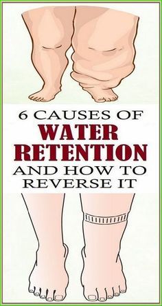 6 Causes of Water Retention and How to Treat It Feminine Health, Prenatal Care, Patient Education, Health Tips For Women, Wellness Inspiration, Healthy Liver, Men's Health Fitness, Water Retention, Environmental Health