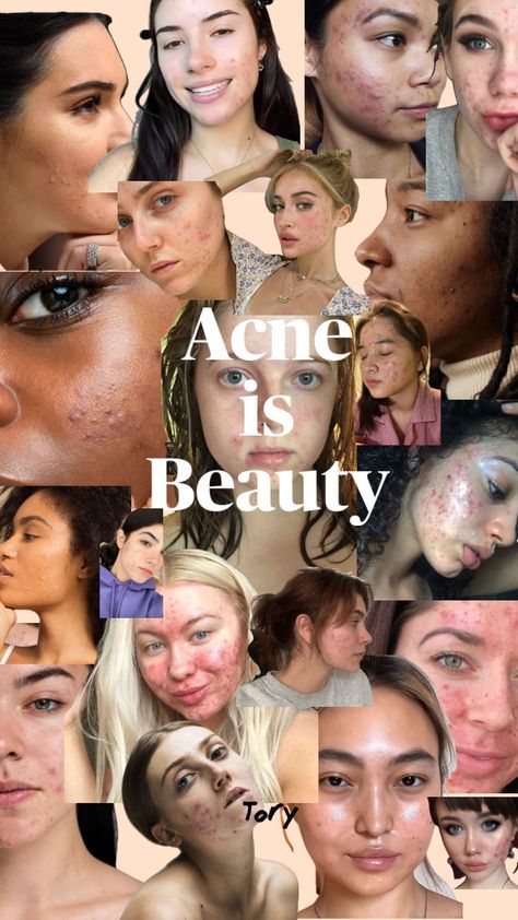 Girl With Acne Aesthetic, Girl With Acne, Celebrity Acne, Love Your Skin, Pretty Skin, Acne Skin, Face Skin Care, Face Skin, You Are Beautiful