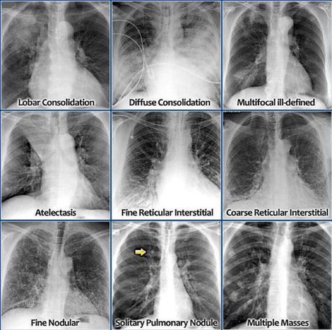 Embedded image Np School, Radiology Student, Radiology Imaging, Pa School, Pulmonology, Medical Student Study, Critical Care Nursing, Respiratory Care, Respiratory Therapy