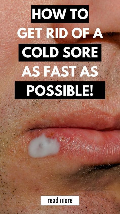 Learn how to get rid of a cold sore with these tried-and-true cold sore remedies and cold sore prevention tips. Discover the most common cold sore causes and triggers, natural remedies, over-the-counter medicines, and essential oils to help you prevent and manage cold sore outbreaks. Tap here for more tips and insights from a lifelong cold sore sufferer! #coldsore #remedies Coldsore Remedies Quick How To Get Rid, How To Get Rid Of A Cold Sore Overnight, Remedies For Cold Sore, Coldsore Remedies Quick Cold Sore, Cold Sore Remedy Overnight How To Get Rid, Best Cold Sore Remedy Overnight, Natural Remedies For Cold Sores, Cold Sores Remedies Overnight, Diy Cold Sore Remedy Fast