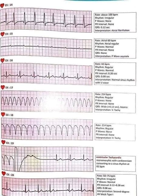 Ecg Reading, Ekg Rhythms, Newborn Nursing, Cardiac Rhythms, Nurse Things, Heart Line, Medical Notes, Nursing Study Guide, College Food