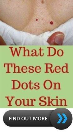 What do these red dots on your skin mean. Red Dots On Skin, Healthy Habits Challenge, What Is Health, Healthy Remedies, Health Signs, Women Health Care, Health Tips For Women, Daily Health Tips, Natural Health Tips