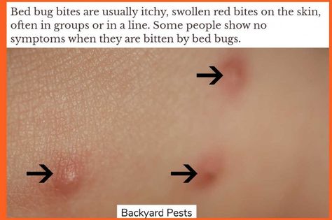 Bed bug bites are one of the signs of bed bugs #bedbugs #bedbugsigns #bedbugbites #backyardpests Bed Bug Bites Remedies, Bed Bugs Bites, Bed Bug Bites Pictures, Oils For Bed Bugs, Types Of Bug Bites, Bed Bugs Essential Oils, Bed Bugs Bites Pictures, Bed Bug Remedies, Essential Oils Bed Bugs