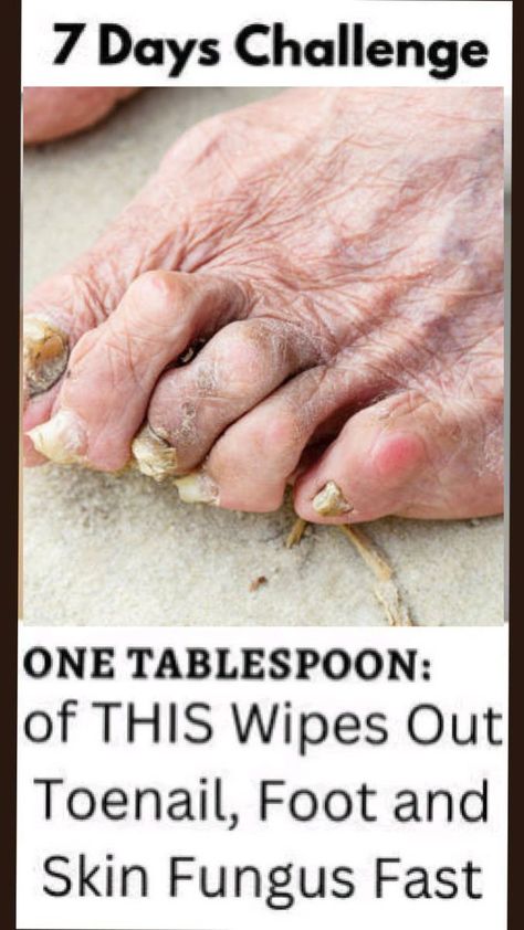 One Tablespoon of this mixture wipes out your Nail and toenail fungus!-7 days challenge! Fungal Infection Remedies, Toenail Health, Toenail Fungal Infection, Toenail Fungus Remedies, Nail Fungus Remedy, 7 Day Challenge, Fungal Nail, Nail Oil, Toenail Fungus