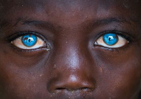 Boy with "Waardenburg syndrome",Ethiopia by Eric Lafforgue Black People With Blue Eyes, Waardenburg Syndrome, People With Blue Eyes, Rare Eye Colors, Rare Eyes, Eye Quotes, Eyes Artwork, Cute Babies Photography, Skin Hand