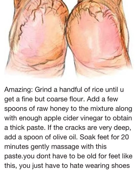 Fix Cracked Heels, Dry Cracked Heels, Cracked Heels, Home Health Remedies, Beauty Remedies, Skin Care Remedies, Body Skin Care Routine, Diy Skin Care, Homemade Beauty Products