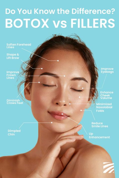 Botox Vs Fillers, Botox Under Eyes, Derma Fillers, Under Eye Fillers, Botox Before And After, Face Fillers, Homemade Face Mask, Hyaluronic Acid Fillers, Cheek Fillers