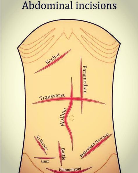 Abdominal Incisions in GENERAL SURGER Abdominal Incisions, Nursing School Pharmacology, Surgical Technologist Student, Medical Terminology Study, Perioperative Nursing, Anatomy Coloring, Surg Tech, Medical Surgery, Surgical Technician