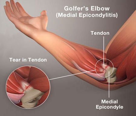 Elbow Stretches, Elbow Exercises, Elbow Pain Relief, Golfers Elbow, Forearm Muscles, Elbow Pain, Tennis Elbow, Mobility Exercises, Sports Injury